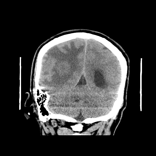 Tuberculoma | Image | Radiopaedia.org