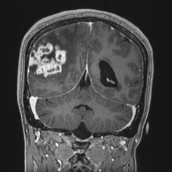 Tuberculoma | Image | Radiopaedia.org