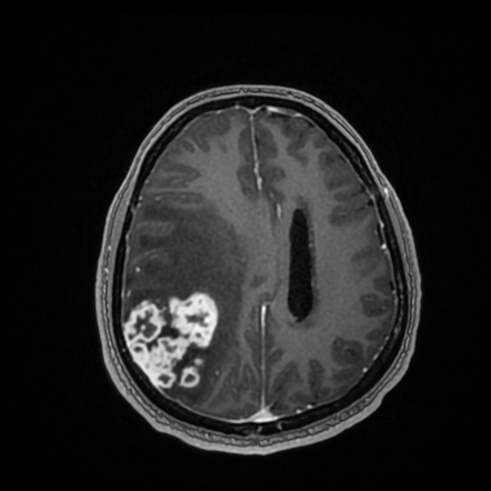 Tuberculoma | Radiology Case | Radiopaedia.org