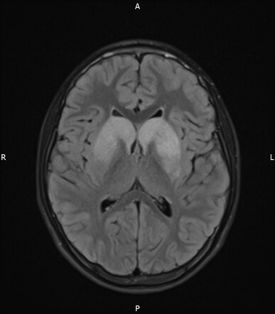 Primary mitochondrial disorders | Radiology Reference Article ...