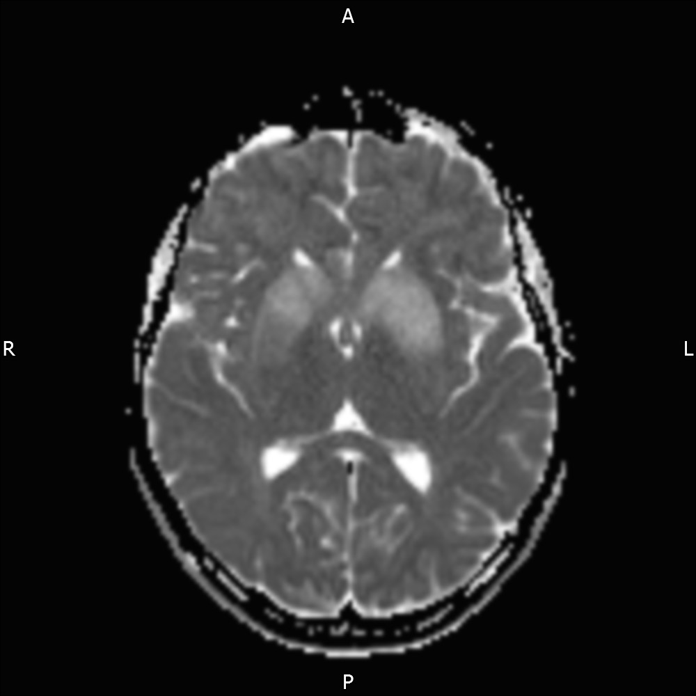 Uremic Encephalopathy | Image | Radiopaedia.org