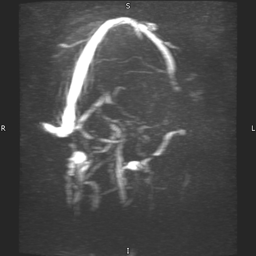 Uremic Encephalopathy | Image | Radiopaedia.org