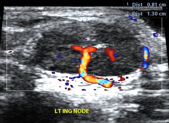 Reactive lymph node hyperplasia | Image | Radiopaedia.org