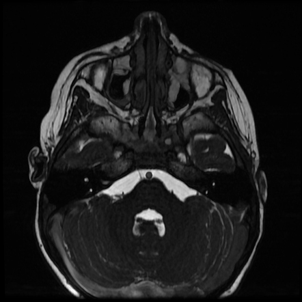 Duane syndrome | Radiology Case | Radiopaedia.org