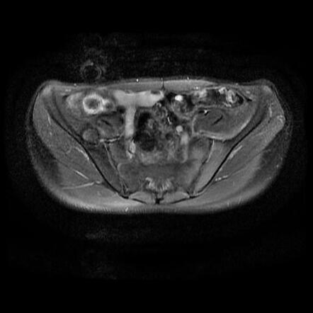 Acute Sacroiliitis | Image | Radiopaedia.org