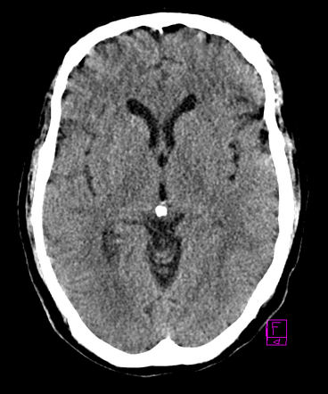 Immune effector cell-associated neurotoxicity syndrome (ICANS ...