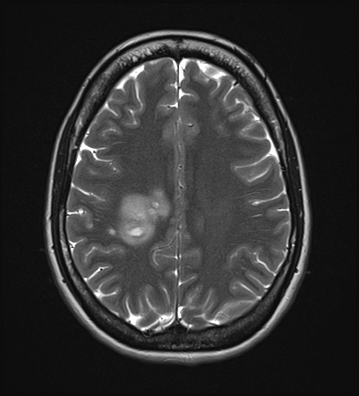 Tumefactive Demyelination Radiology Case Radiopaedia Org