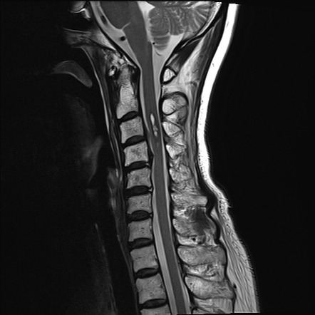 Cavernoma cervical spine - radiation-induced | Radiology Case ...