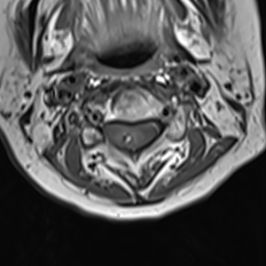 Cavernoma cervical spine - radiation-induced | Image | Radiopaedia.org