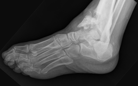 Ankle Charcot neuroarthropathy | Image | Radiopaedia.org