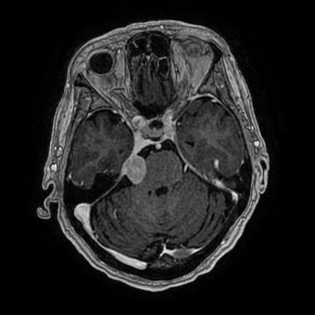 Cerebellopontine angle meningioma | Radiology Case | Radiopaedia.org