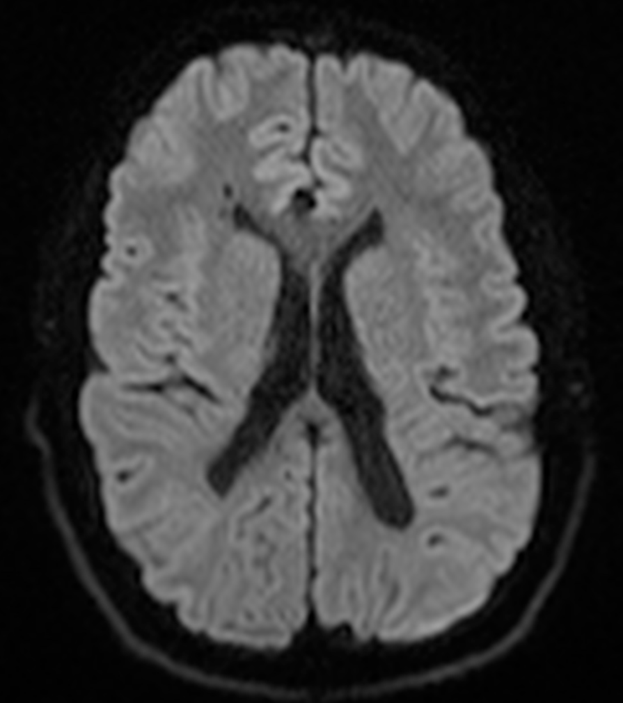 Periventricular leukomalacia | Image | Radiopaedia.org