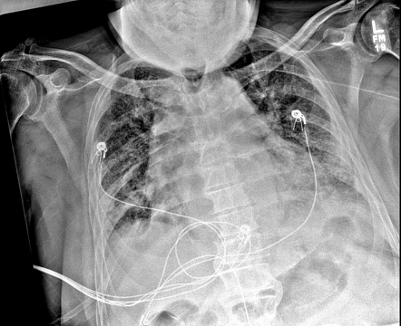 Malpositioned PICC | Image | Radiopaedia.org