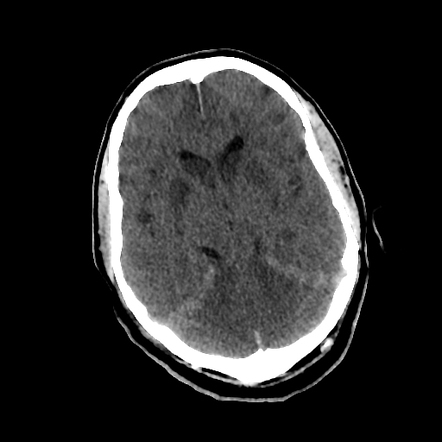 Anoxic brain injury | Radiology Case | Radiopaedia.org