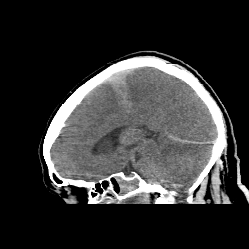 Anoxic Brain Injury | Image | Radiopaedia.org