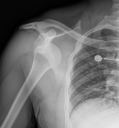 Posterior Shoulder Dislocation 