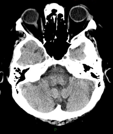 Nocardia brain abscesses | Image | Radiopaedia.org