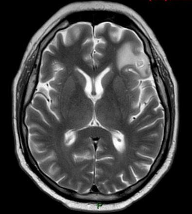 Nocardia brain abscesses | Image | Radiopaedia.org