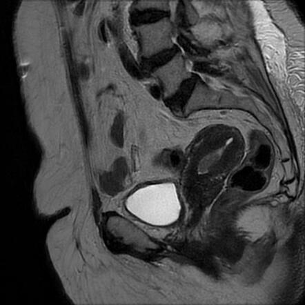 Endometrioid adenocarcinoma of the endometrium | Radiology Case ...