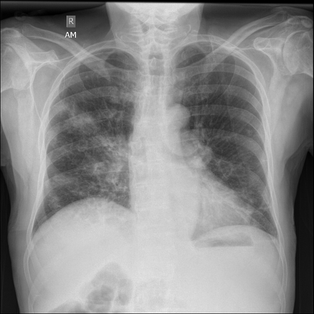 Right upper lobe community-acquired pneumonia | Radiology Case ...