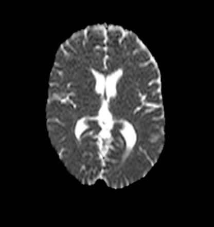 Multiple System Atrophy (MSA-C) | Image | Radiopaedia.org