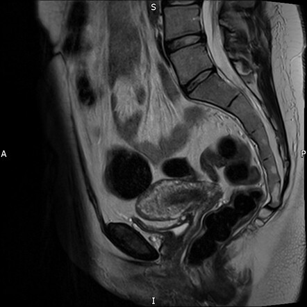 Uterus Didelphys | Radiology Case | Radiopaedia.org