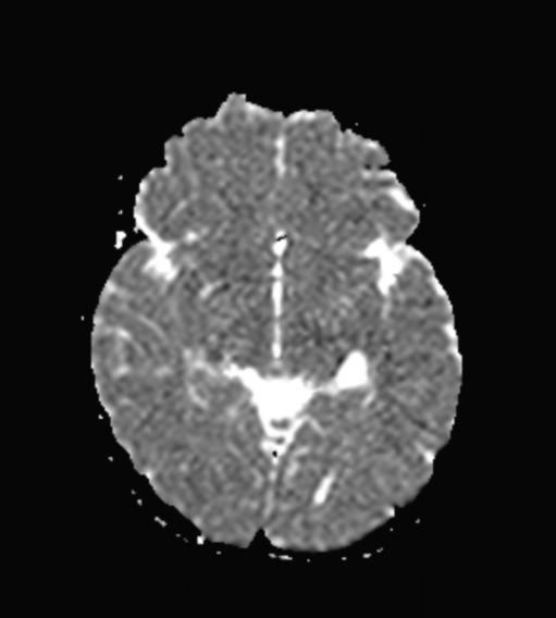 Choroidal fissure cyst | Image | Radiopaedia.org