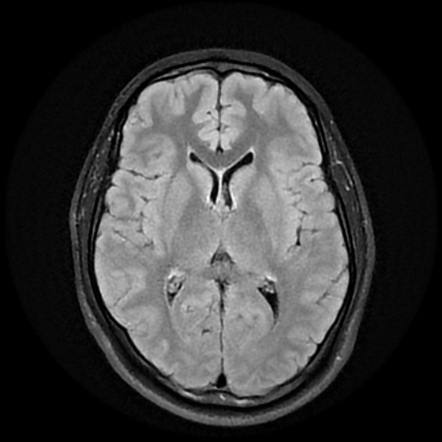 Rathke cleft cyst - T2 hypointense | Image | Radiopaedia.org