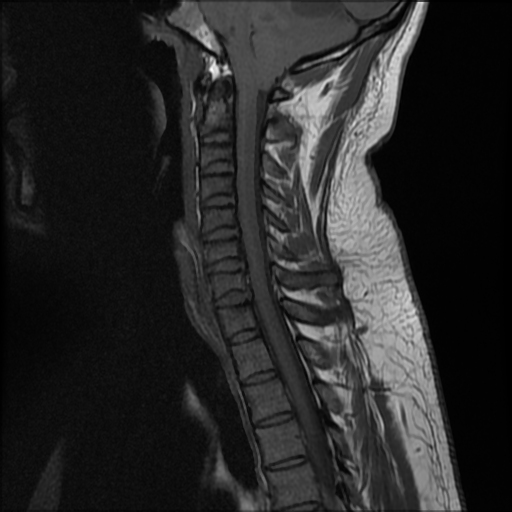 Cerebellar hemangioblastoma | Image | Radiopaedia.org