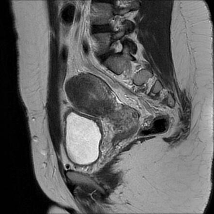 Focal adenomyosis with ovarian endometriomas | Radiology Case ...