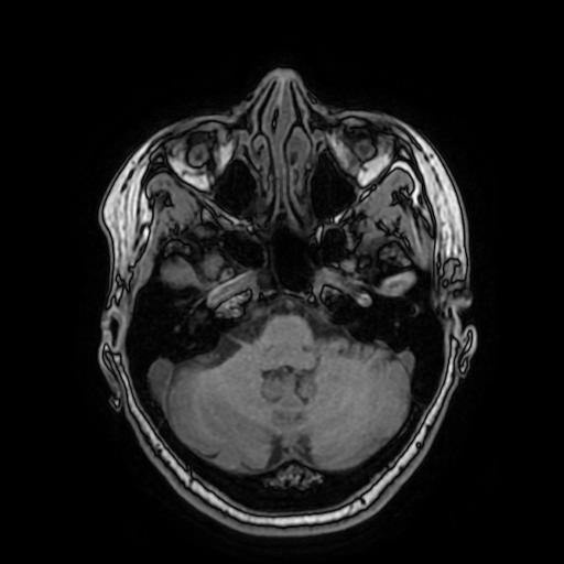 Meningioma Posterior Cranial Fossa Image 0208