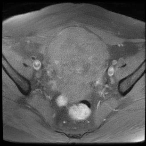 Uterine Leiomyoma With Cystic Degeneration Image 1944