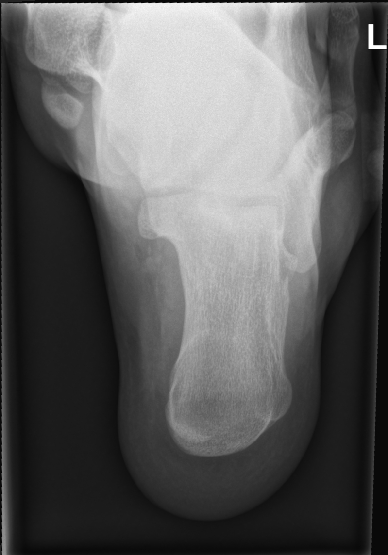 Retrocalcaneal Bursitis