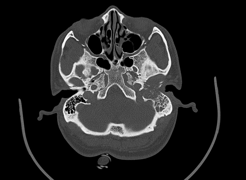 Squamous cell carcinoma of the external auditory canal | Image ...