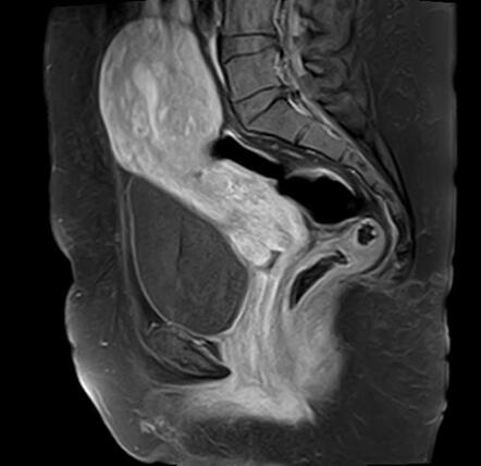 Diffuse uterine adenomyosis with subperitoneal involvement | Image ...