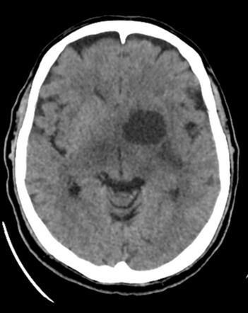 Glioblastoma, IDH-wildtype | Radiology Case | Radiopaedia.org