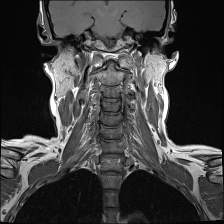 Carotid body paraganglioma - SDHD mutation | Image | Radiopaedia.org