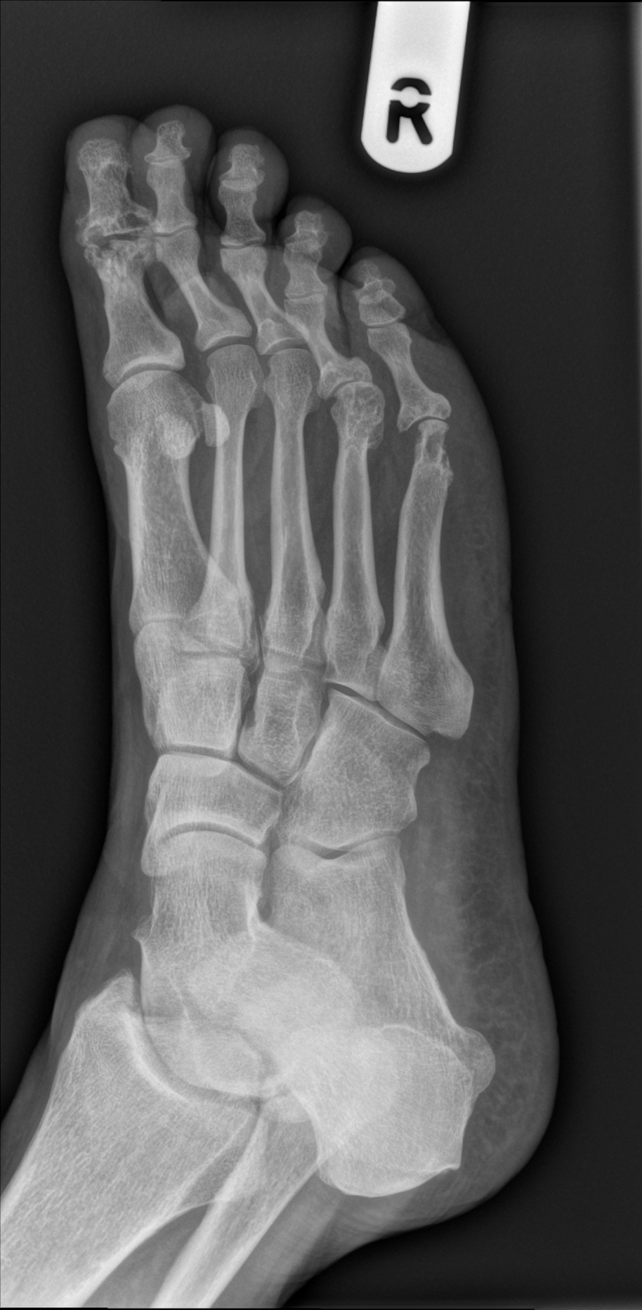 Rheumatoid arthritis - feet | Image | Radiopaedia.org