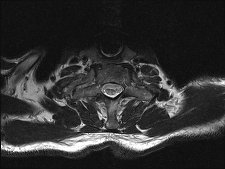 Subacute combined degeneration of the cord | Radiology Case ...