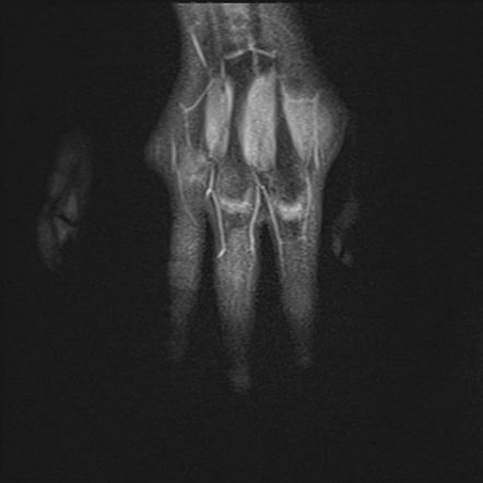 Phalangeal Enchondroma Image Radiopaedia Org