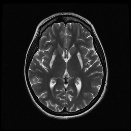 Methanol poisoning | Radiology Case | Radiopaedia.org