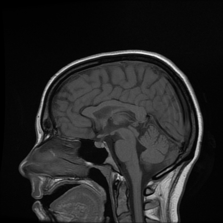 Methanol poisoning | Image | Radiopaedia.org