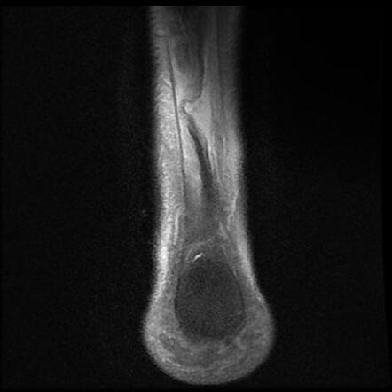 Achilles Tendon Rupture | Radiology Case | Radiopaedia.org