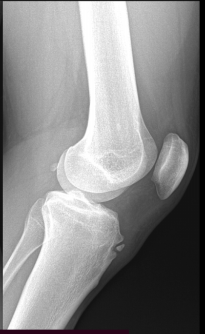 Osgood-Schlatter disease - adult | Image | Radiopaedia.org