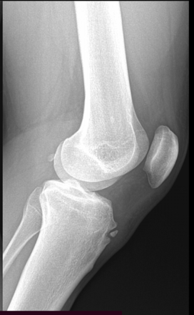 Osgood-Schlatter disease - adult | Radiology Case | Radiopaedia.org