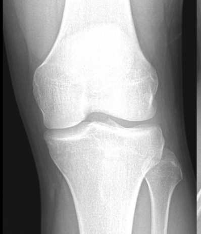 Osgood-Schlatter disease - adult | Image | Radiopaedia.org