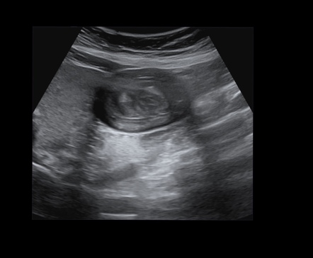 Gastric intussusception | Image | Radiopaedia.org