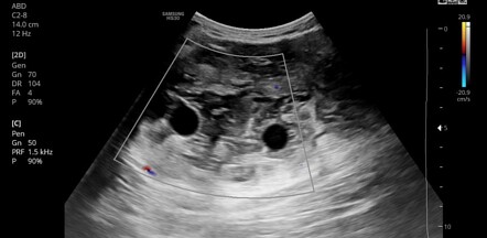 Intramuscular hydatid cyst | Image | Radiopaedia.org