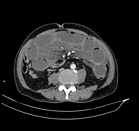 Closed loop small bowel obstruction | Image | Radiopaedia.org