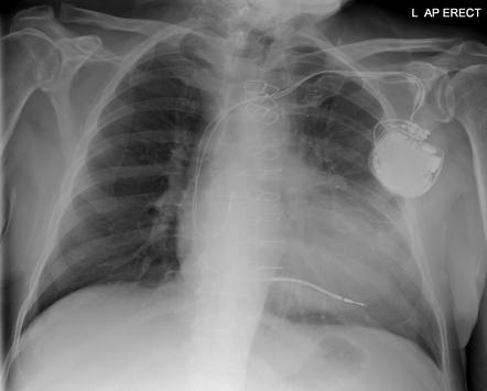 Retained pacing wire | Radiology Case | Radiopaedia.org